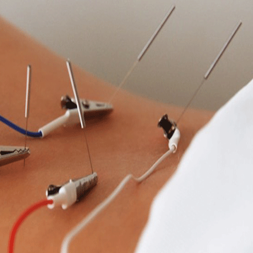Electroacupuncture 